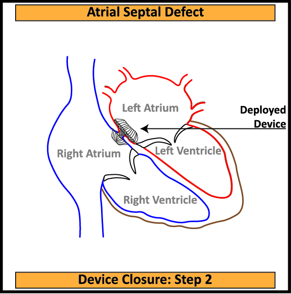 4-ASD-Device-Closure-First-Step-2