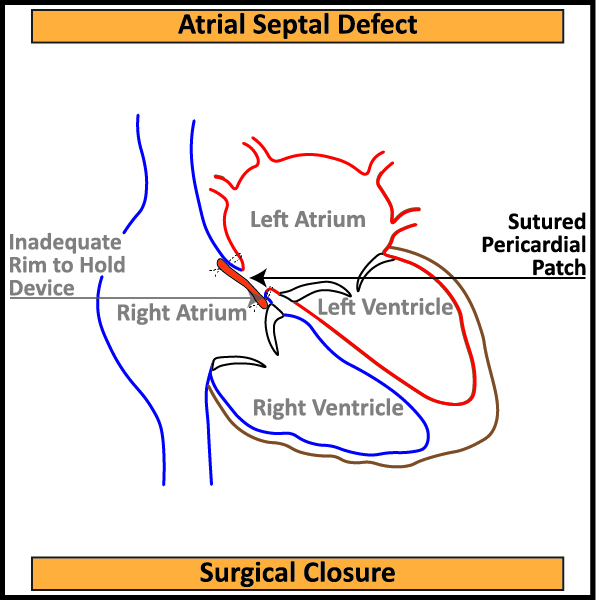 6-Atrial-Septal-Defect-Surgical-Closure