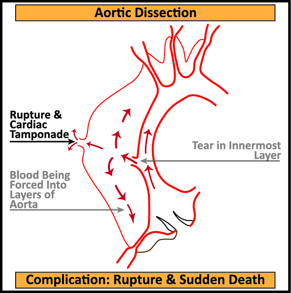 Aortic-Dissection-Complication-Rupture-Sudden-Death