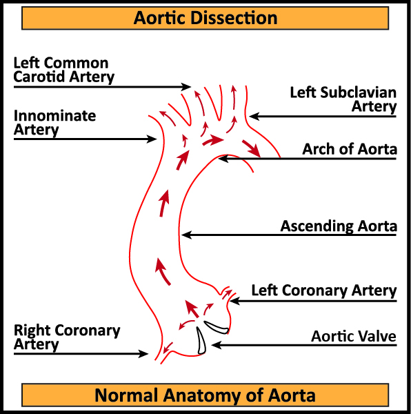 Aortic-Dissection-Normal-Aorta