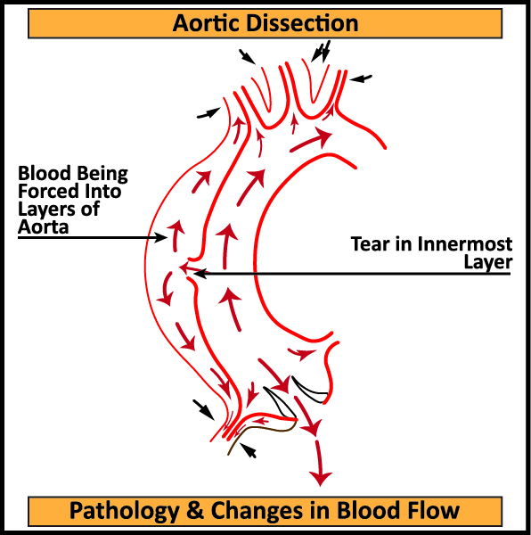 Aortic-Dissection-Pathology-Changes-in-Blood-Flow