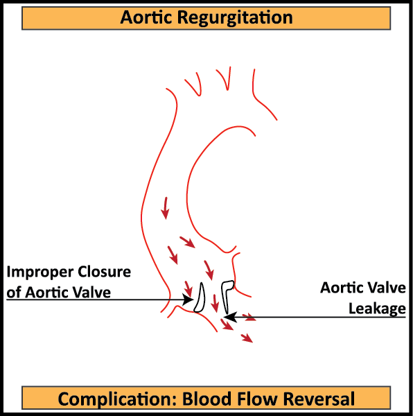 Aortic-Regurgitation-Complication-Reversal-of-Blood-FLow