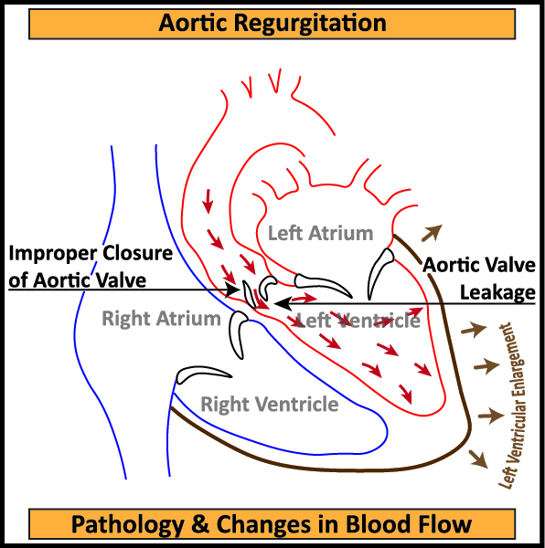 Aortic-Regurgitation-Pathology-Changes-in-Blood-Flow