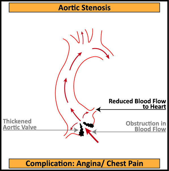 Aortic-Stenosis-Complication-Angina-Chest-Pain