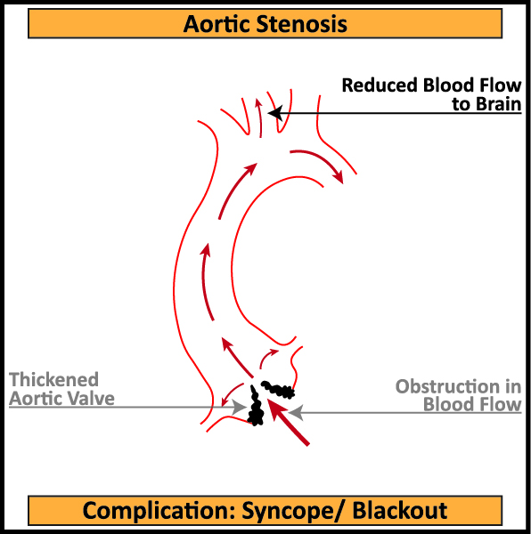 Aortic-Stenosis-Complication-Syncope-Blackout