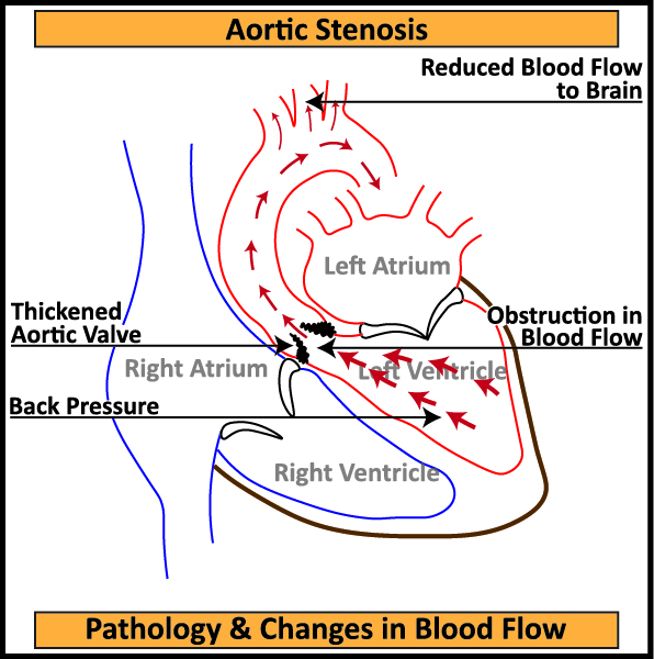 Aortic-Stenosis-Pathology-Changes-in-Blood-Flow