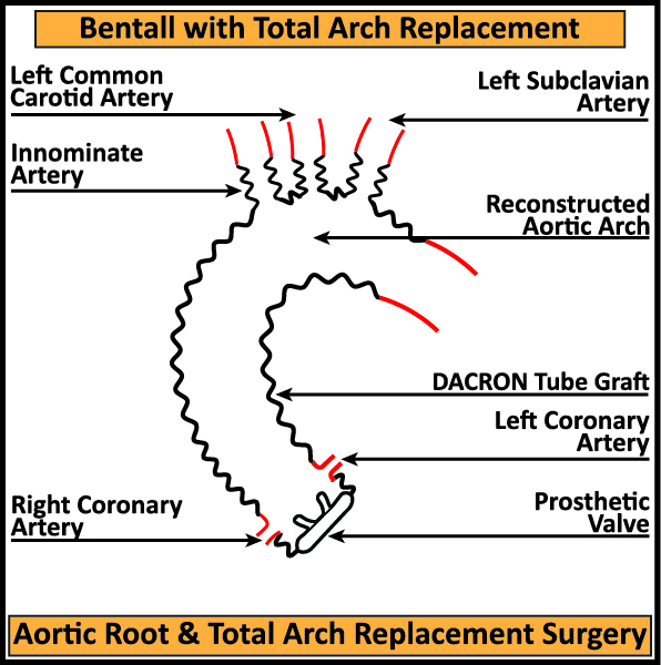 Bentall-with-Aortic-Root-Total-Arch-Replacement-Surgery