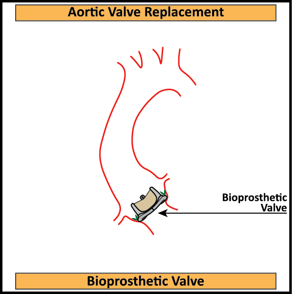 Bioprosthetic-Aortic-Valve-In-Situ