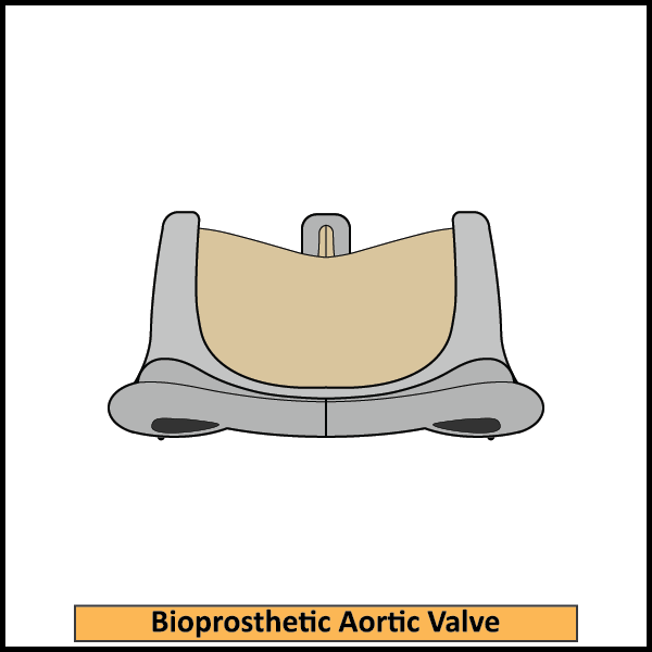 Bioprosthetic-Aortic-Valve