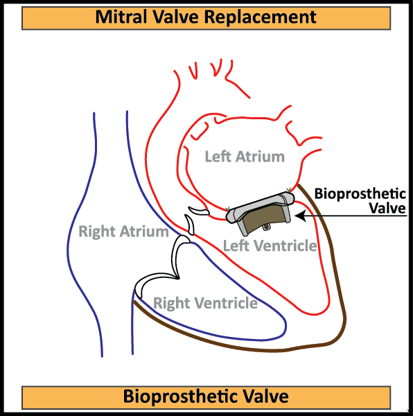 Bioprosthetic-Mitral-Valve-In-Situ