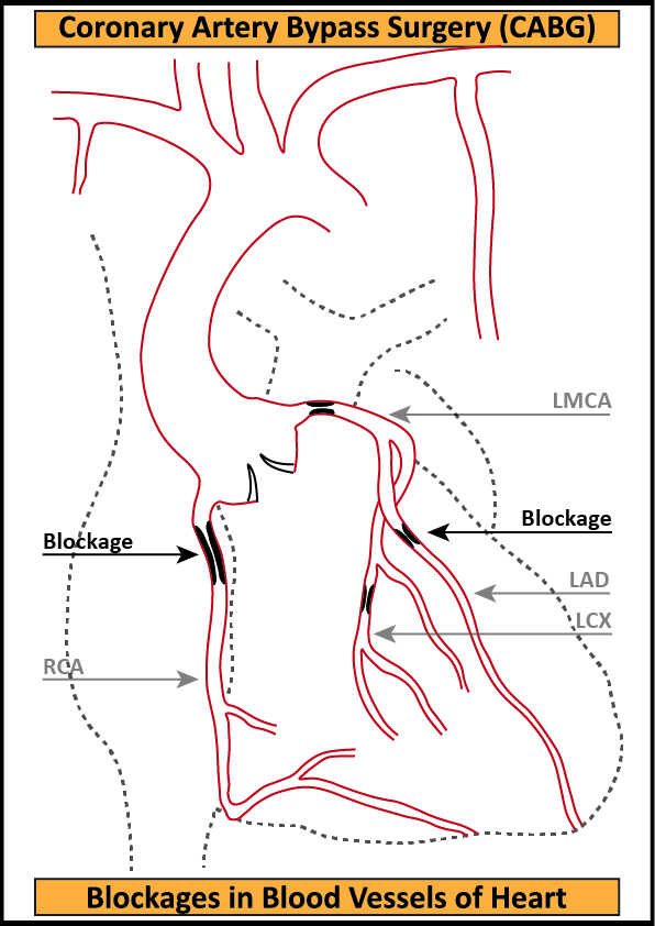 CABG-2-Blockages-in-Blood-Vessels-of-Heart