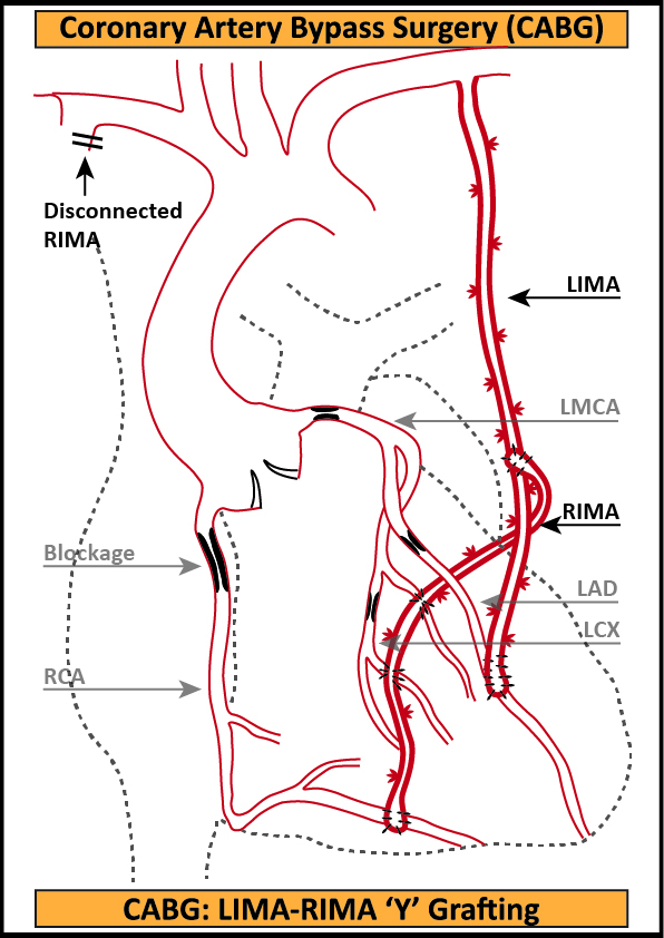 CABG-3-LIMA-RIMA-Y-Grafting