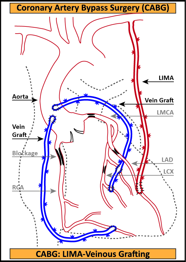 CABG-4-LIMA-Veinous-Grafting