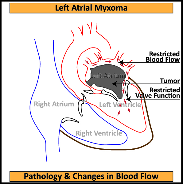 Left-Atrial-Myxoma-Pathology-Changes-in-Blood-Flow