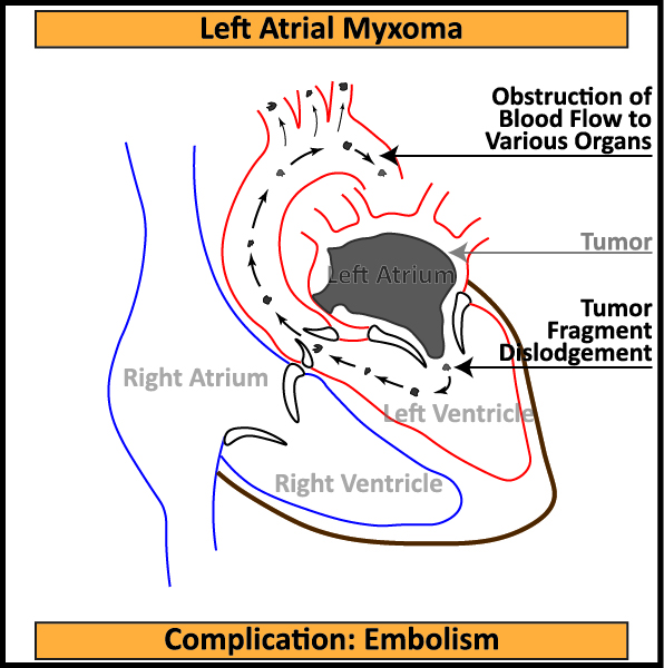 Left-Axial-Myxoma-Complication-Embolism