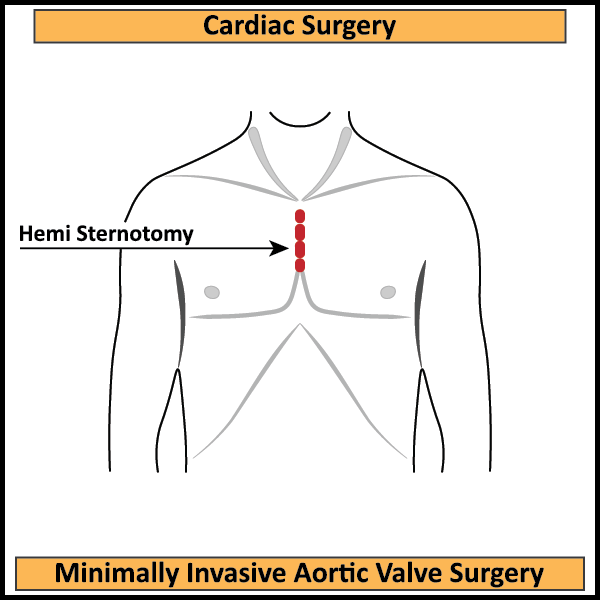 MICS-AVR-Hemi-Sternotomy