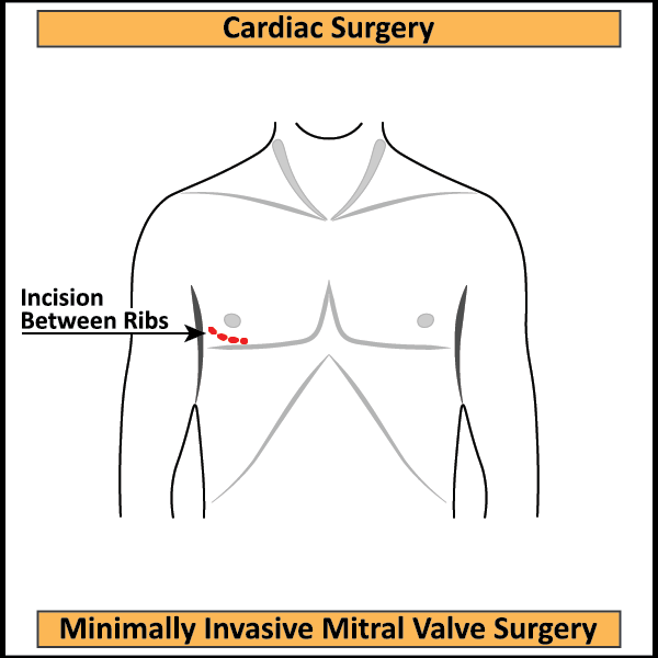 MICS-MVR-Thoractomy