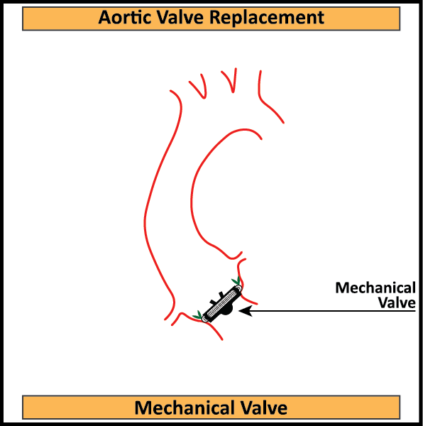 Mechanical-Aortic-Valve-In-Situ