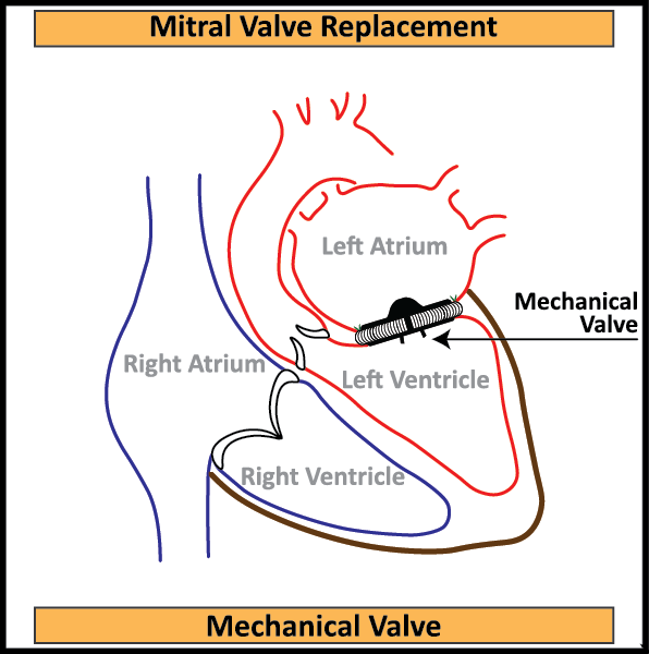 Mechanical-Mitral-Valve-In-Situ