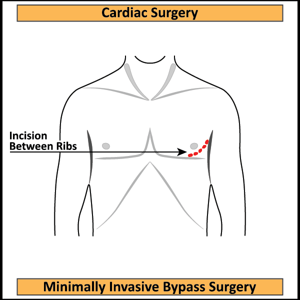 Minimally-Invasive-Bypass-Surgery