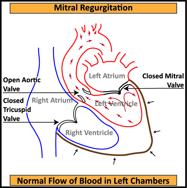 Mitral-Regurgitation-Normal-Blood-Flow-in-Left-Chambers