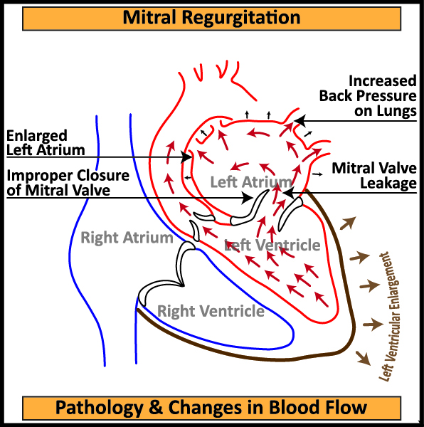 Mitral-Regurgitation-Pathology-Changes-in-Blood-Flow-1