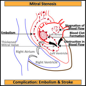 Minimally Invasive Mitral Valve Replacement - drkanase.in