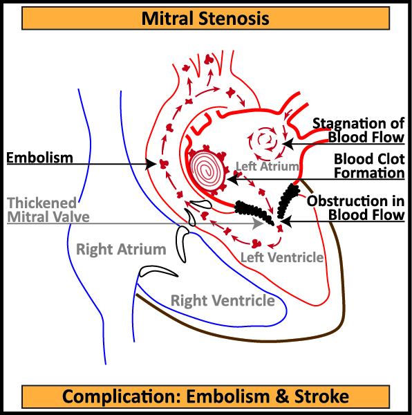 Mitral-Stenosis-1-Complication-Embolism-Stroke