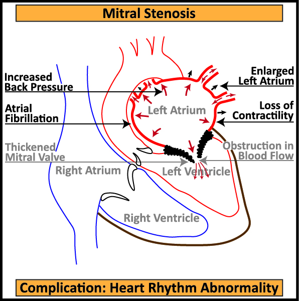 Mitral-Stenosis-2-ComplicationHeart-Rhythm-Abnormality