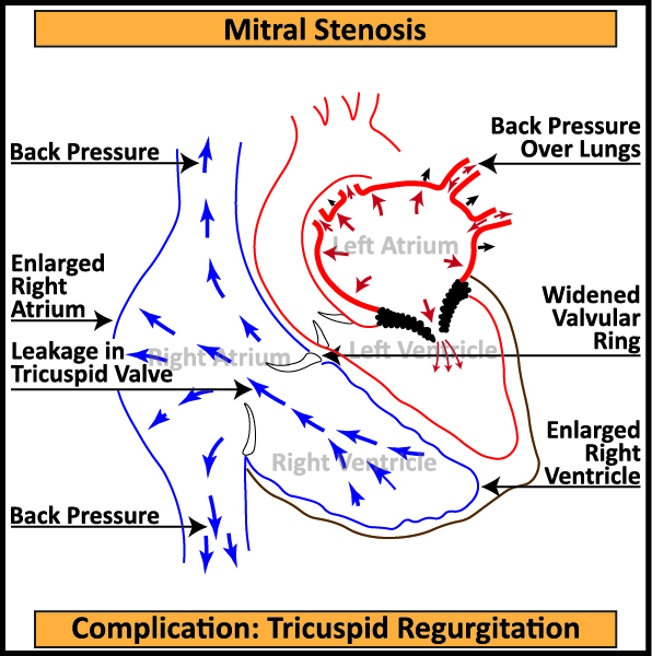 Mitral-Stenosis-3-Complication-Tricuspid-Regurgitation