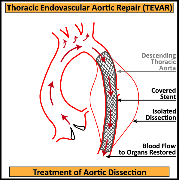 TEVAR-Aortic-Dissection-Treatment