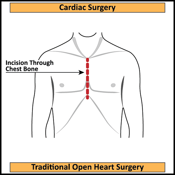 Traditional-Open-Heart-Surgery