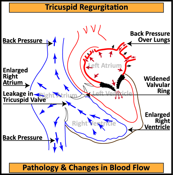 Tricuspid-Regurgitation-Pathology-Changes-in-Blood-Flow