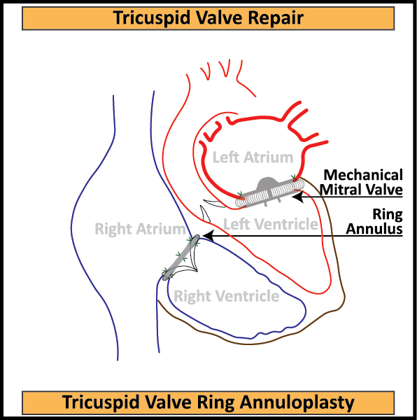 Tricuspid-Valve-Repair-Ring-Annuloplasty-1